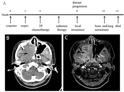 Clinicopathological molecular characterizations of sinonasal NUT carcinoma: a report of two cases and a literature review